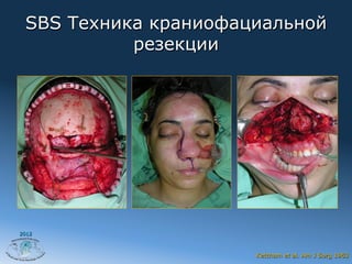 SBS Техника краниофациальной
           резекции




2012



                      Ketcham et al. Am J Surg 1963
 