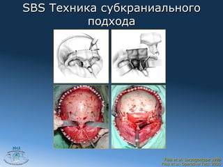 SBS Техника субкраниального
                 подхода




2012


                              Fliss et al. Laryngoscope 1999
                            Fliss et al. Operative Tech 2000
 