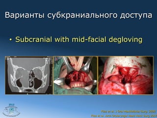 Варианты субкраниального доступа


 •  Subcranial with mid-facial degloving




2012


                               Fliss et al. J Oral Maxillofacial Surg. 2000
                        Fliss et al. Arch Otolaryngol Head Neck Surg 2007
 