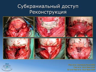 Субкраниальный доступ
           Реконструкция




2012
                         Fliss et al. Neurosurg Focus 2002
                                Fliss et al. Skull Base 2007
                        Gil and Fliss et al. Skull Base 2007
 