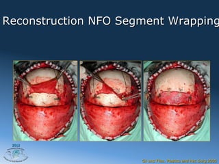 Reconstruction NFO Segment Wrapping




 2012




                      Gil and Fliss. Plastics and Rec Surg 2005
 