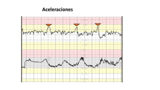 Aceleraciones
 