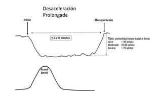Desaceleración
Prolongada
 