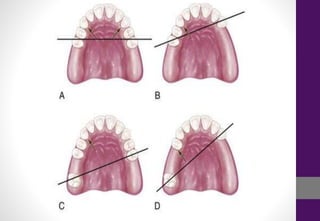 Removable partial dentures full information | PDF