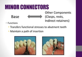 MINORCONNECTORS
• Functions
• Transfers functional stresses to abutment teeth
• Maintain a path of insertion
Base
Other Components
(Clasps, rests,
Indirect retainers)
 