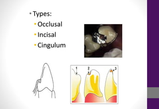•Types:
• Occlusal
• Incisal
• Cingulum
 