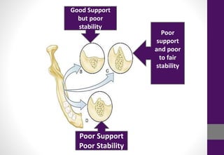 Good Support
but poor
stability
Poor Support
Poor Stability
Poor
support
and poor
to fair
stability
 