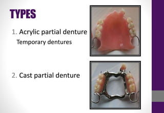 TYPES
1. Acrylic partial denture
Temporary dentures
2. Cast partial denture
 
