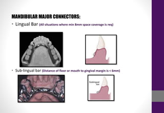 MANDIBULAR MAJOR CONNECTORS:
• Lingual Bar (All situations where min 8mm space coverage is req)
• Sub-lingual bar (Distance of floor or mouth to gingival margin is < 6mm)
 