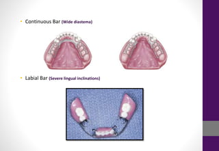 • Continuous Bar (Wide diastema)
• Labial Bar (Severe lingual inclinations)
 