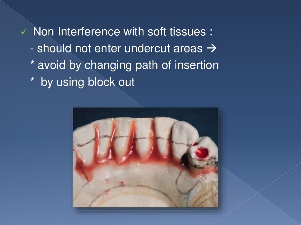 RPD Major Connectors