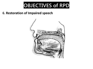 Removable Partial Denture 1. Introduction | PDF
