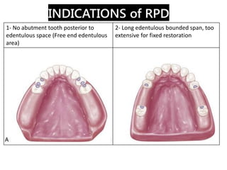 INDICATIONS of RPD
4- With excessive loss of residual bone,
the use of labial flange or need to
restore lost tissues as sp...