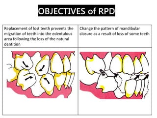 OBJECTIVES of RPD
3. Restore the Continuity of the dental Arch
to Improve Masticatory Function
 