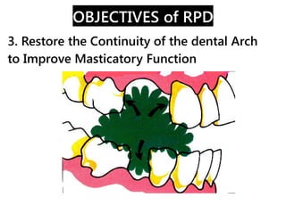 OBJECTIVES of RPD
4. Improvement of Esthetics, and Providing Support to
the Paraoral Muscles, Lips and Cheeks
 