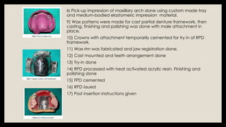 Partial Registration Rim Precision Attachment in Removable Partial Denture: Concepts and ...