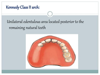 Kennedy Class II arch:
Unilateral edentulous area located posterior to the
remaining natural teeth
 