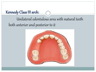 Kennedy Class III arch:
Unilateral edentulous area with natural teeth
both anterior and posterior to it
 