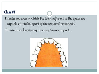 Class VI :
Edentulous area in which the teeth adjacent to the space are
capable of total support of the required prosthesis.
This denture hardly requires any tissue support.
 