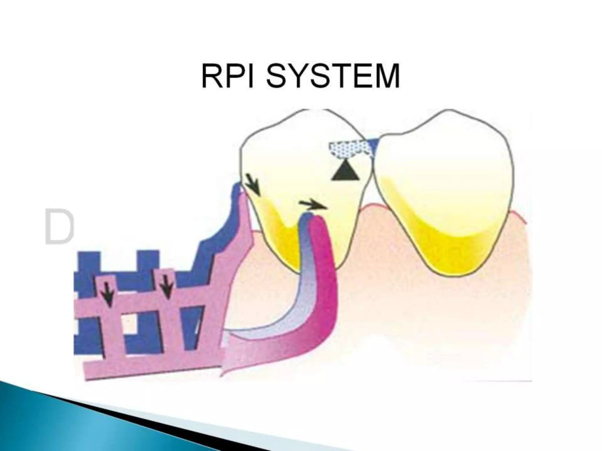 Lever Arm Rpd Rpd biomechanics principles of levers design consideration 4th year | PPT