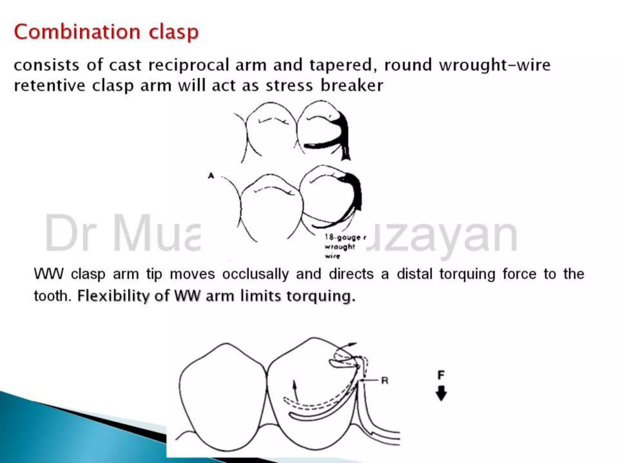 Lever Arm Rpd Rpd biomechanics principles of levers design consideration 4th year | PPT