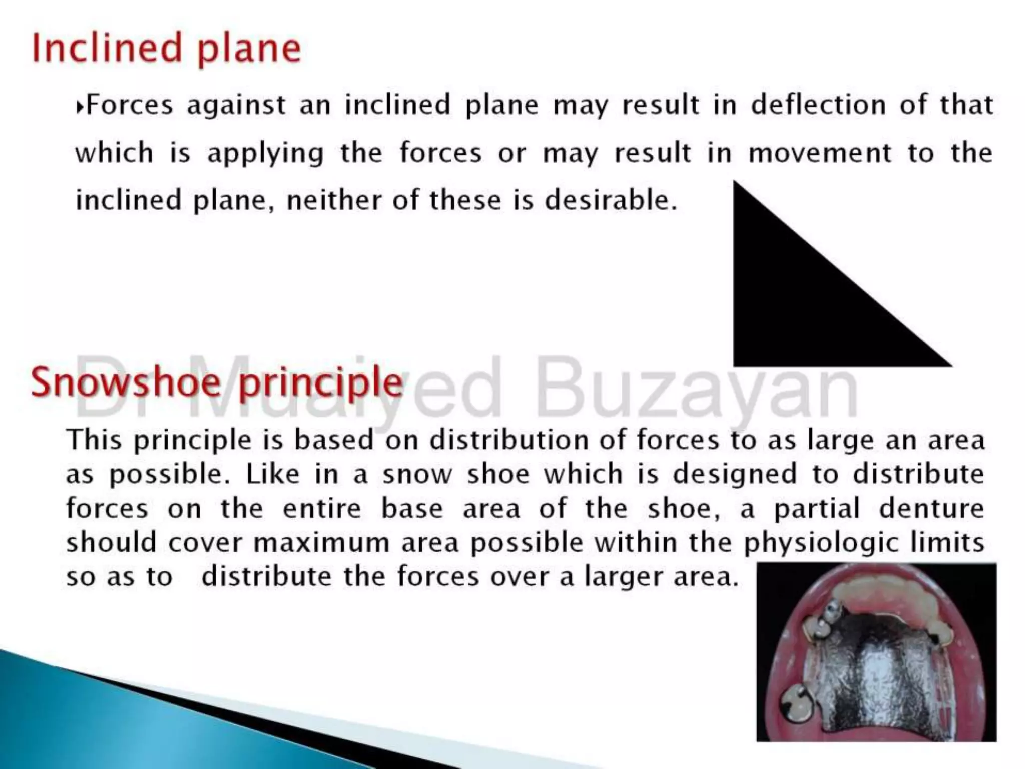 Lever Arm Rpd Rpd biomechanics principles of levers design consideration 4th year | PPT