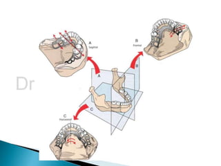Lever Arm Rpd Rpd biomechanics principles of levers design consideration 4th year | PPTX