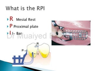 Lever Arm Rpd Rpd biomechanics principles of levers design consideration 4th year | PPTX