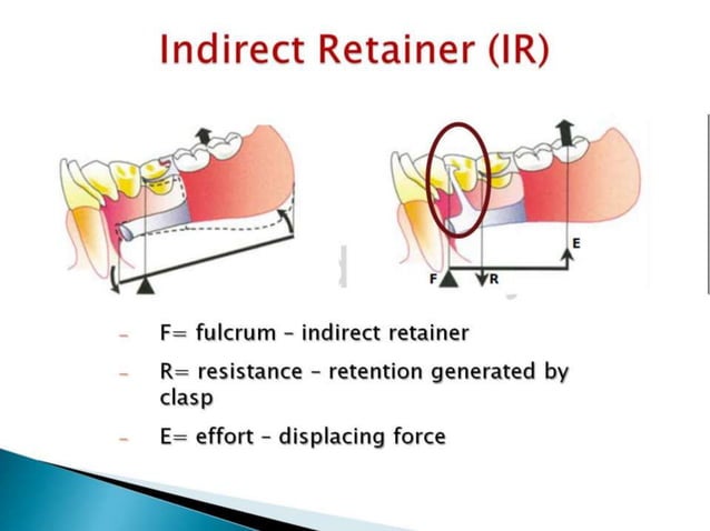 Lever Arm Rpd Rpd biomechanics principles of levers design consideration 4th year | PPT