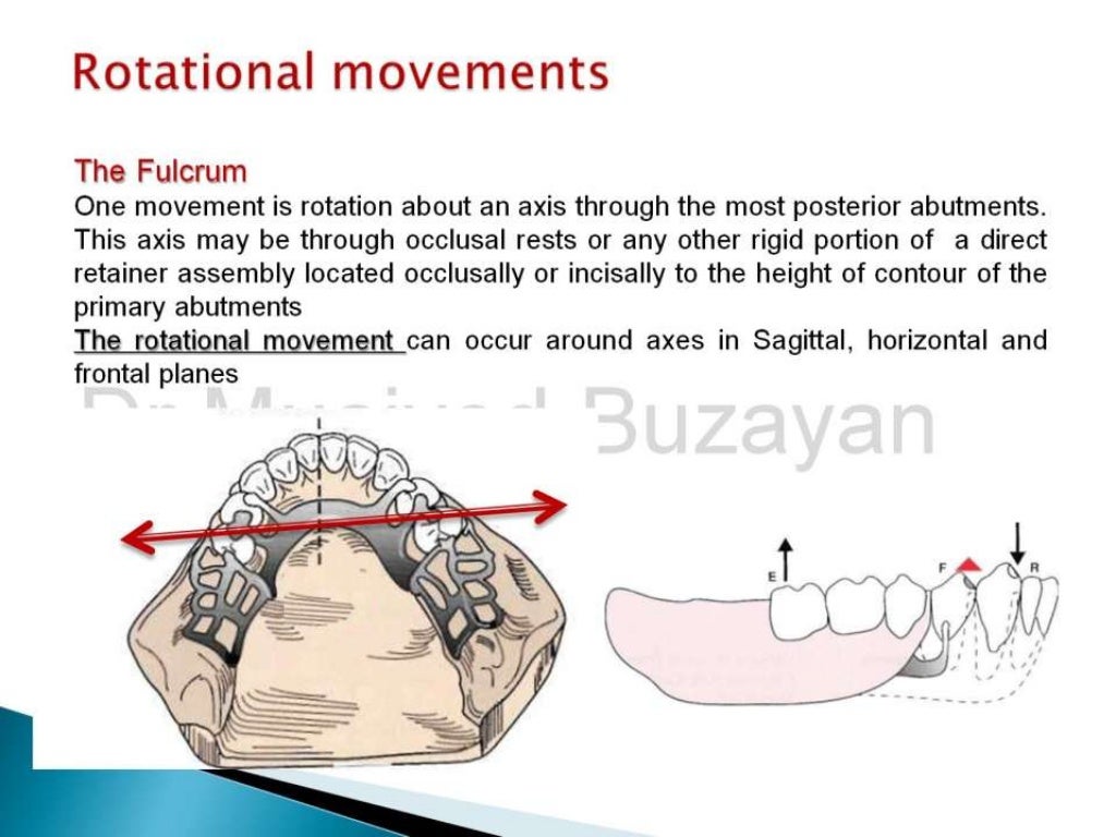 Rpd biomechanics principles of levers design consideration 4th year