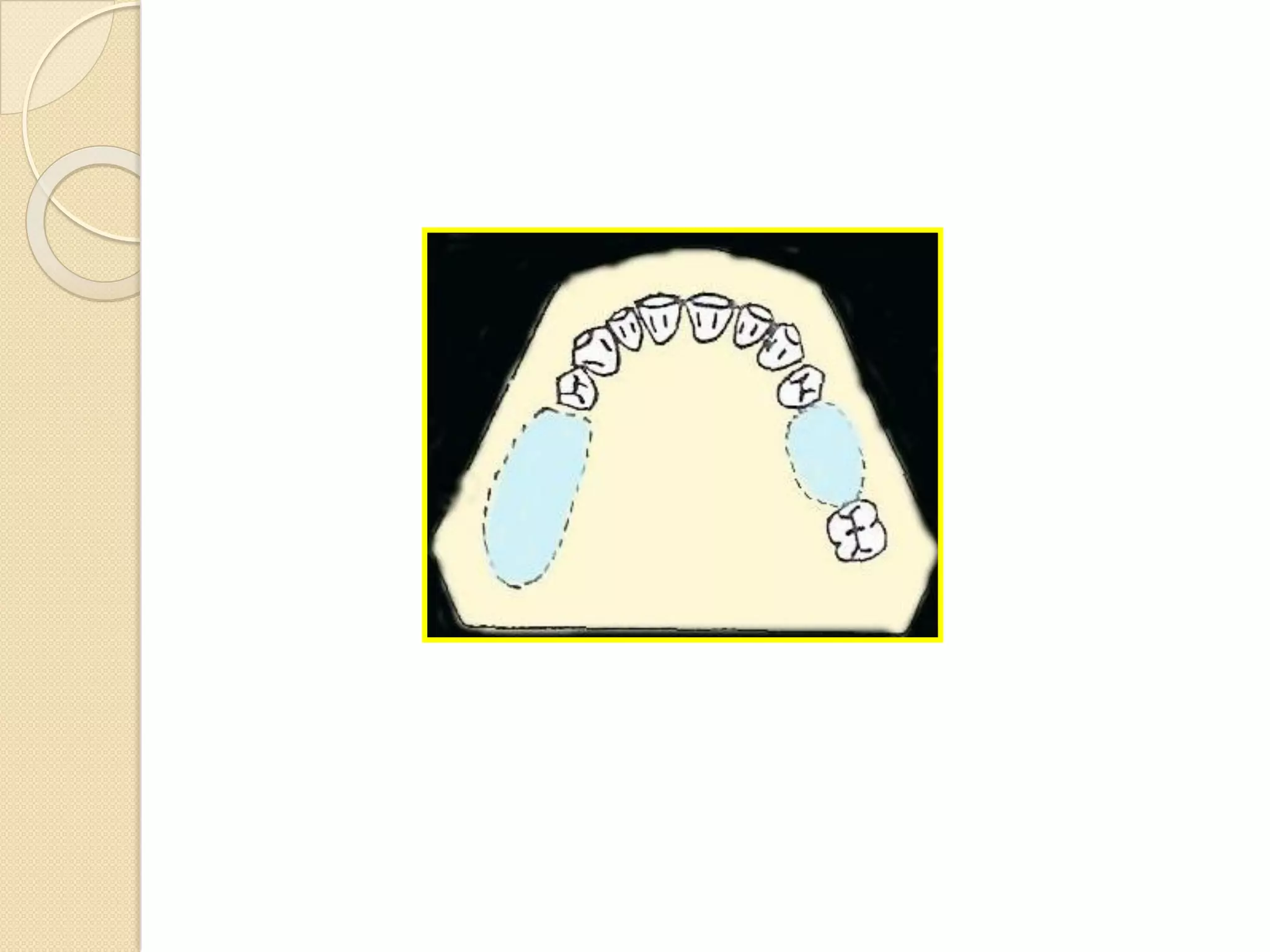 RPD Classification. | PDF