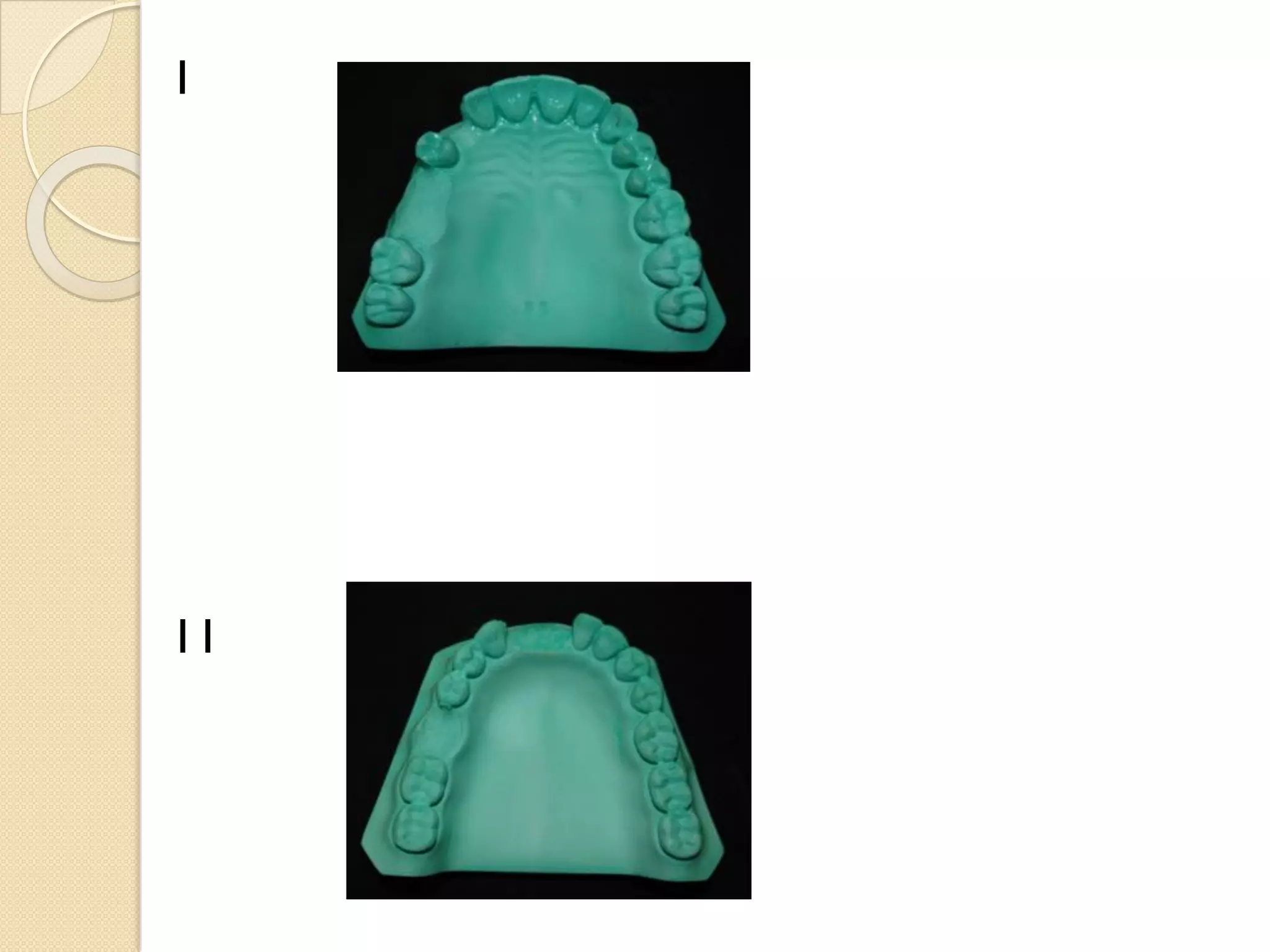 RPD Classification. | PDF