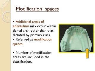 Edentulous Class Rpd RPD Classification. | PDF