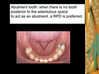 removable partial denture rpd classification.pdf