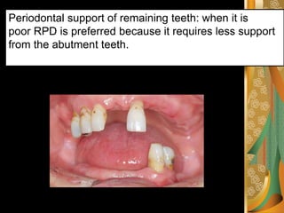 removable partial denture rpd classification.pdf