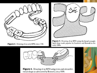 Removable Rpd Lower Ant removable partial denture rpd classification.pdf