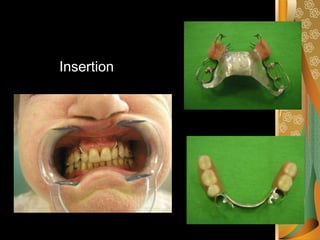 One Unit Rpd removable partial denture rpd classification.pdf