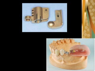 removable partial denture rpd classification.pdf