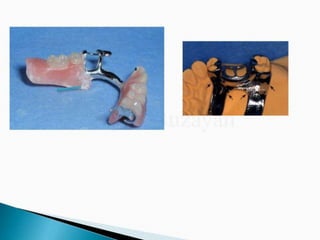 Rpd component + major connectors 2nd yr