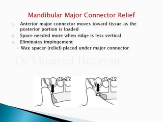 Rpd component + major connectors 2nd yr