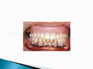 Rpd component + major connectors 2nd yr