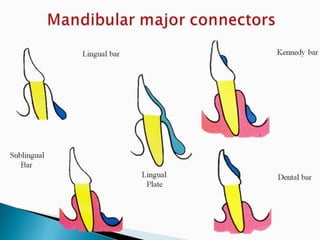 Rpd component + major connectors 2nd yr