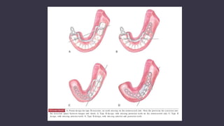Max Rpd Rpd consideration in maxillofacial prosthetics | PPTX
