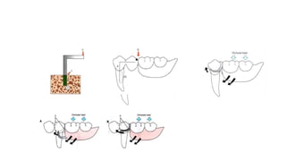 removable partial denture design and design process | PPTX