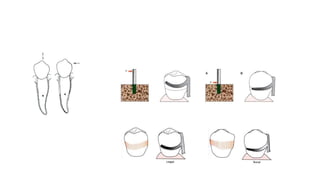 removable partial denture design and design process | PPTX