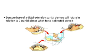 removable partial denture design and design process | PPTX