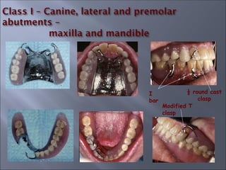 I
bar
½ round cast
clasp
Modified T
clasp
 