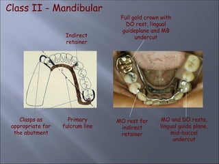 Class II - Mandibular
Indirect
retainer
Primary
fulcrum line
Clasps as
appropriate for
the abutment
MO and DO rests,
lingual guide plane,
mid-buccal
undercut
MO rest for
indirect
retainer
Full gold crown with
DO rest, lingual
guideplane and MB
undercut
 
