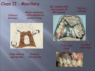Class II - Maxillary
Indirect
Retainer
Clasp arms as
appropriate
Primary
fulcrum line
Major connector
– anteroposterior
palaltal strap
ML cingulum ball
rest as part of
RPI system
Indirect
retainer
½ round
cast clasp
T-bar cast
clasp
 
