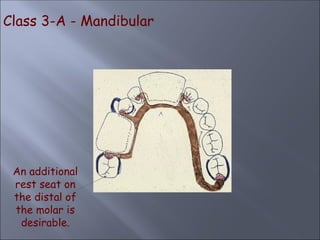 Class 3-A - Mandibular
An additional
rest seat on
the distal of
the molar is
desirable.
 